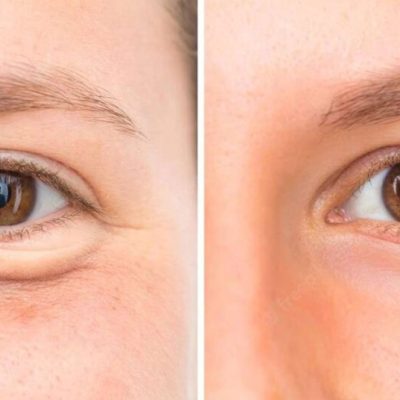 Diferentes-tecnicas-de-blefaroplastia_-qual-escolher_-1024x536