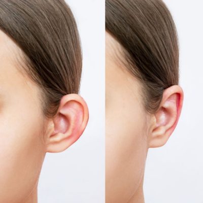 otoplastia-orelhas-de-abano-clinica-humanitare